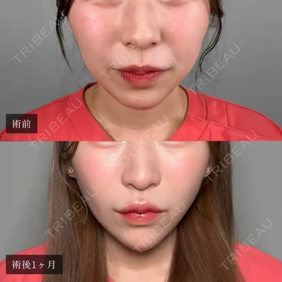 小顔美肌再生（リフトアップ）＋顔の脂肪吸引＋エラのボトックス小顔注射＋顎（あご）のヒアルロン酸注射＋ほうれい線のヒアルロン酸注射 after画像 メイン用