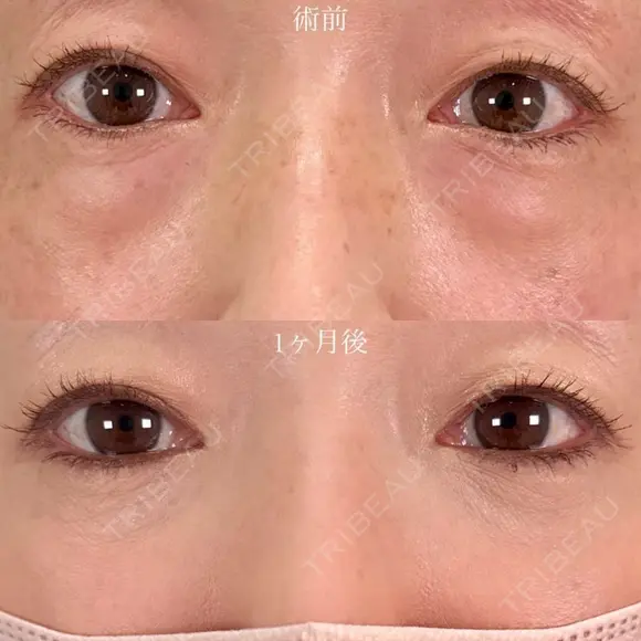 目の下のクマ取り・目の下のたるみ（ふくらみ）取り＋目の下（くぼみ）のヒアルロン酸注射＋シワ取り再生注射（スネコス注射） 30日後 メイン用