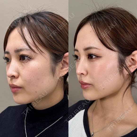 TCB小顔リフト＋小顔美肌再生（リフトアップ）＋エラのボトックス小顔注射＋顎（あご）のヒアルロン酸注 before画像 メイン用
