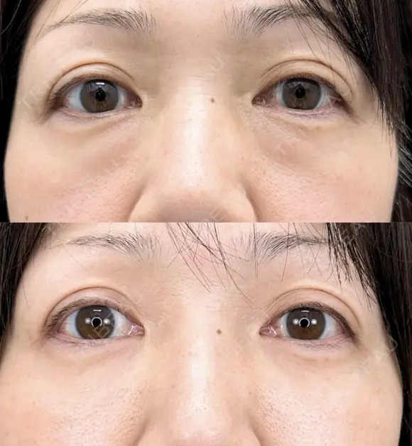 目の下のクマ取り・目の下のたるみ（ふくらみ）取り＋目の下（くぼみ）のヒアルロン酸注射 after画像 メイン用