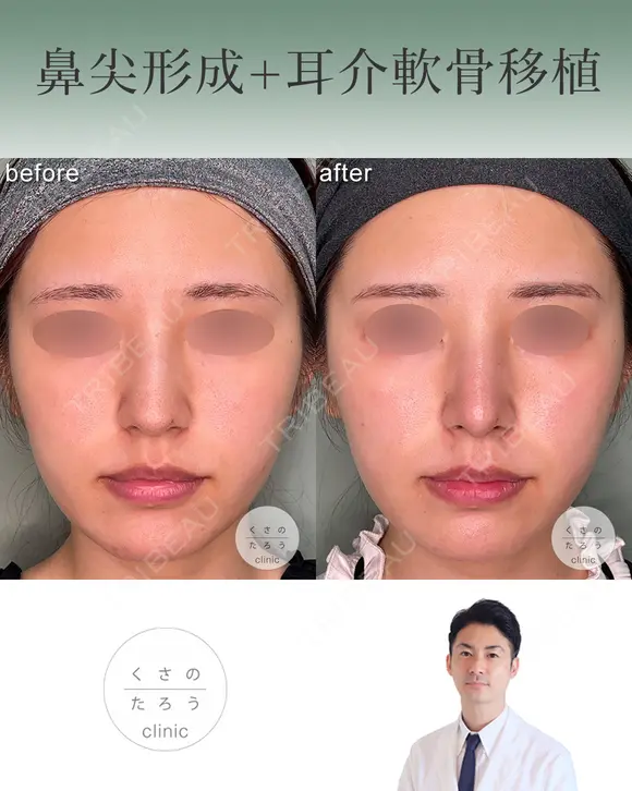 鼻尖形成+耳介軟骨移植 after画像 メイン用