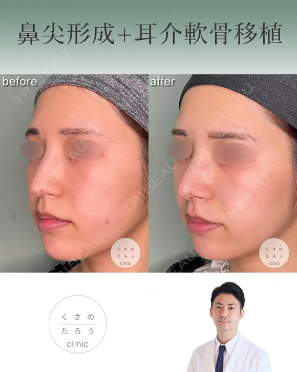 鼻尖形成+耳介軟骨移植 after画像 メイン用