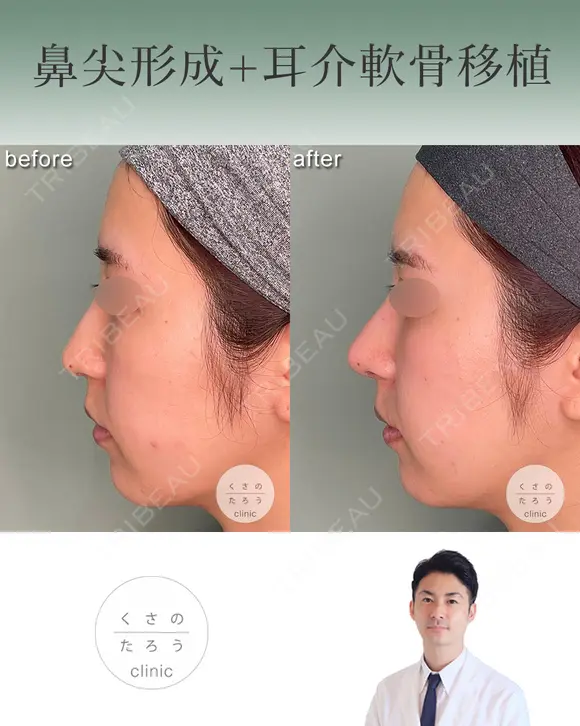 鼻尖形成+耳介軟骨移植 after画像 メイン用