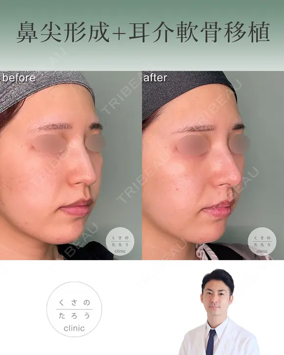 鼻尖形成+耳介軟骨移植 after画像 メイン用