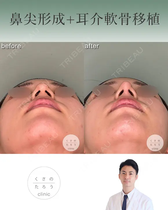 鼻尖形成+耳介軟骨移植 after画像 メイン用