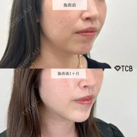 顔の脂肪吸引＋切らない顎形成 3D Eライン＋小顔美肌再生（リフトアップ） before画像 メイン用