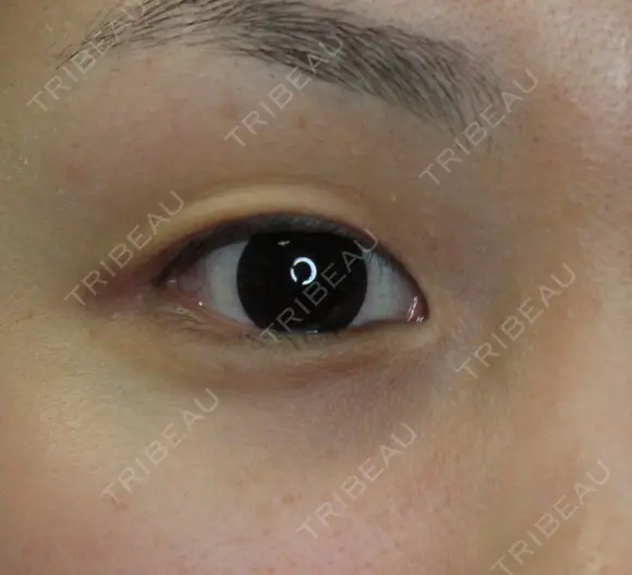 【20代女性・腫れにくい二重術】マイクロメソッド＋α（直後） before画像 メイン用