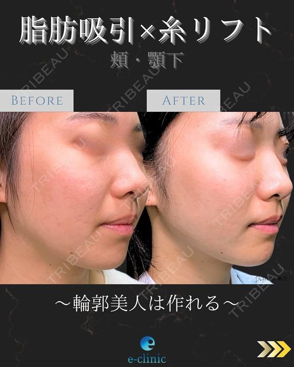 顔の脂肪吸引＋糸リフト 30日後 メイン用