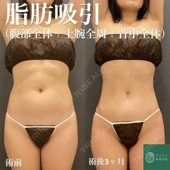コンプリート脂肪吸引（上下腹部・ウエスト・腰）シリンジ法/形成外科専門医✨ after画像 メイン用