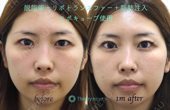 【筒井院長モニター】脱脂術リポトランスファー＋脂肪注入（リポキューブ使用） before画像 メイン用