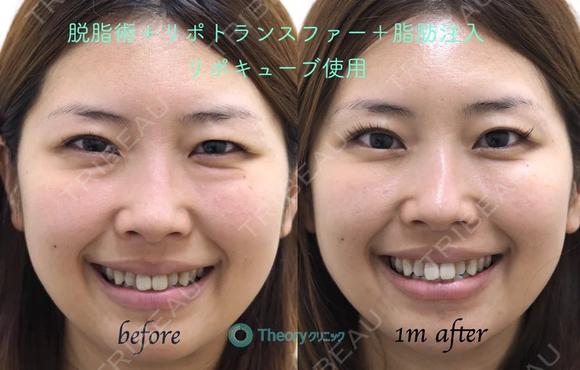 【筒井院長モニター】脱脂術リポトランスファー＋脂肪注入（リポキューブ使用） 30日後 メイン用