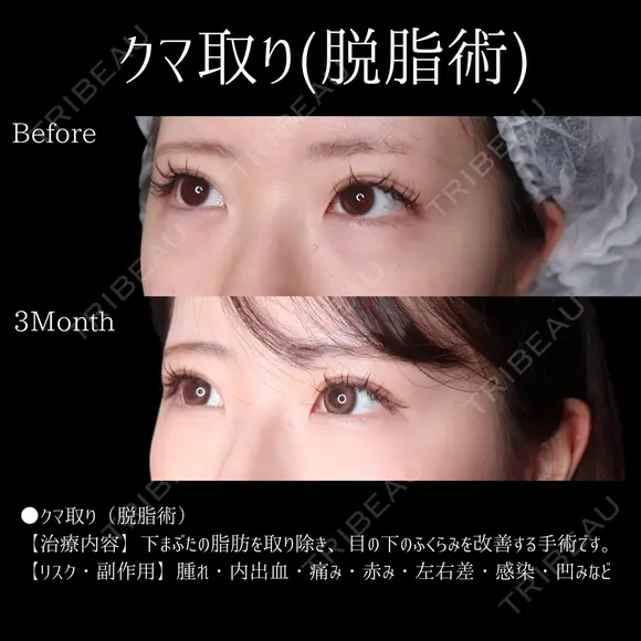 切らない目の下のクマ取り(脱脂術) before画像 メイン用