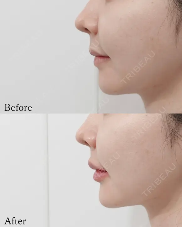 Eライン形成 before画像 メイン用