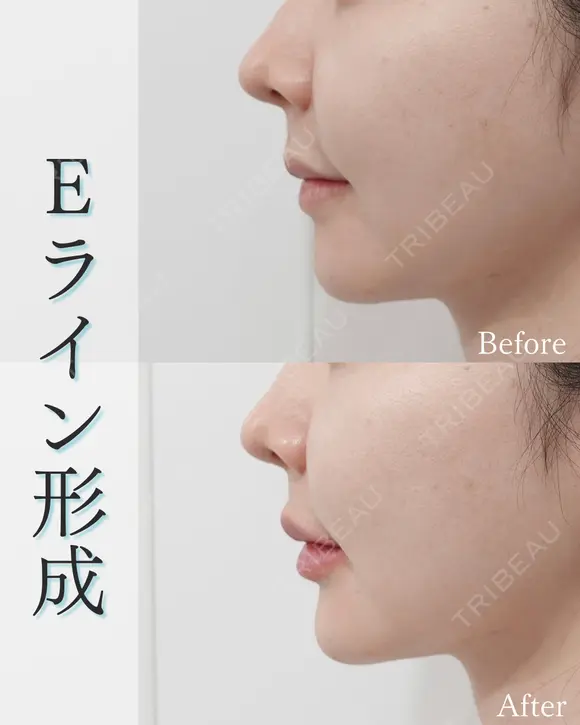 Eライン形成 after画像 メイン用
