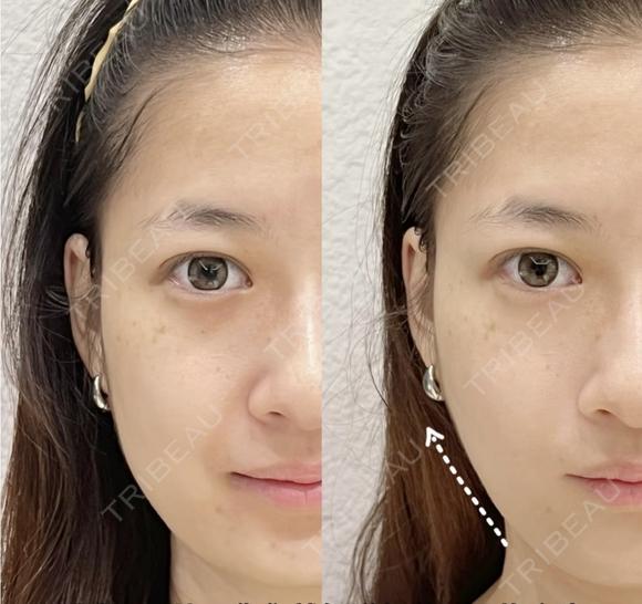 ハイフシャワー600ショット after画像 メイン用