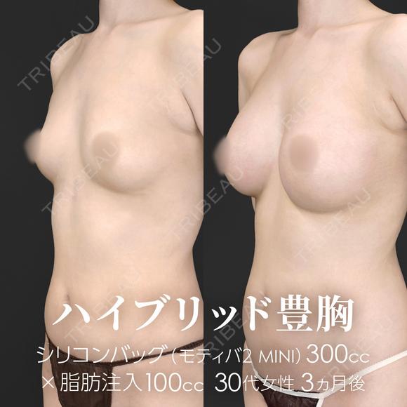 ハイブリッド豊胸（シリコンバッグ豊胸＋脂肪幹細胞注入豊胸） before画像 メイン用