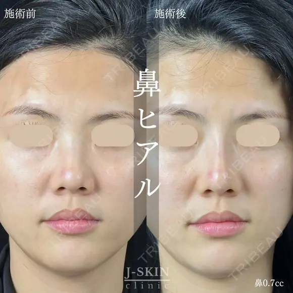 アラガン社ジュビダームビスタ使用✨鼻ヒアル0.7㏄💉 after画像 メイン用