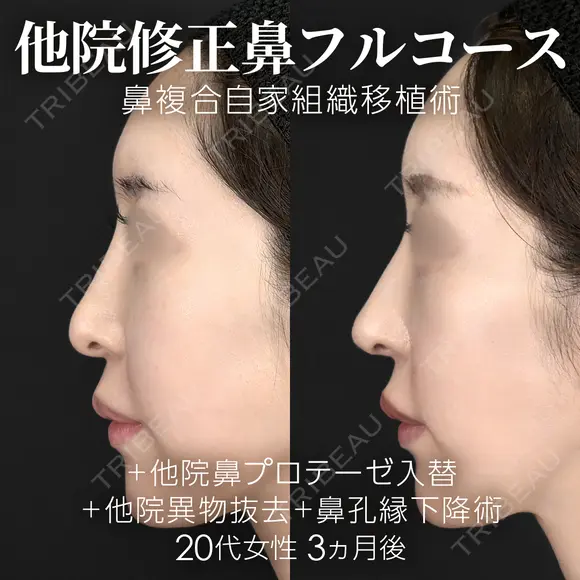 他院異物除去＋他院鼻プロテーゼ入替＋鼻フルコース（鼻複合自家組織移植術）＋鼻孔縁下降術 before画像 メイン用