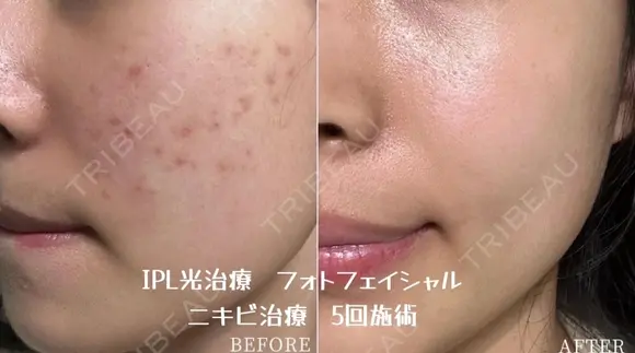 フォトフェイシャルニキビ治療 before画像 メイン用
