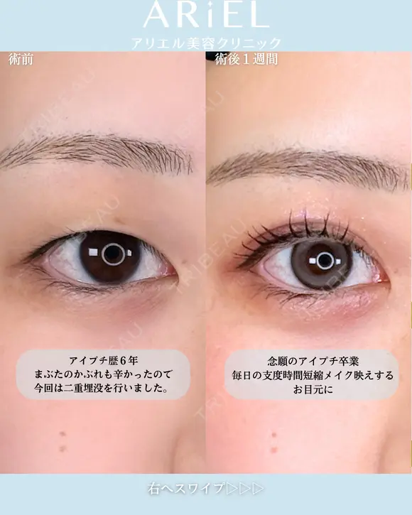 アリエルクイックループトリプル二重埋没法 before画像 メイン用