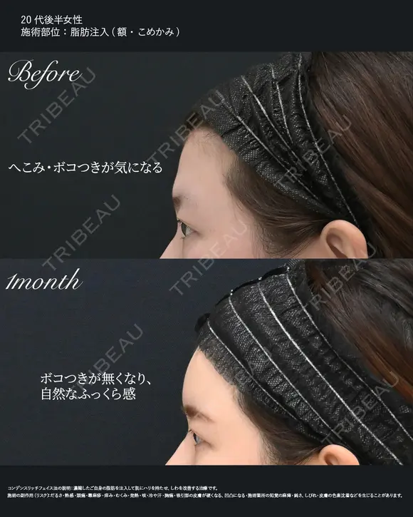 額・こめかみの脂肪注入 (コンデンスリッチ) before画像 メイン用