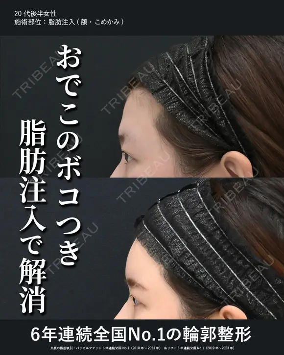 額・こめかみの脂肪注入 (コンデンスリッチ) 30日後 メイン用