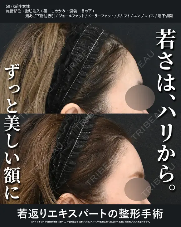 額・こめかみの脂肪注入 (コンデンスリッチ) 30日後 メイン用