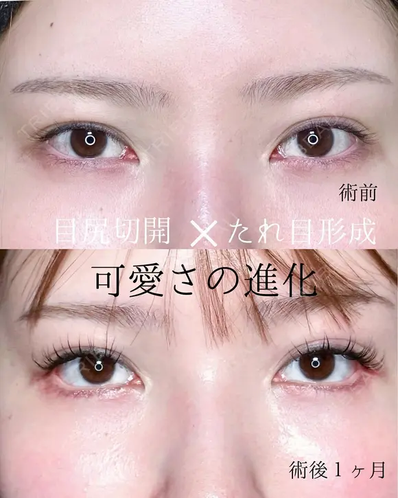 目尻切開＋下眼瞼拡大・下制限（タレ目形成） 皮膚＋結膜 before画像 メイン用