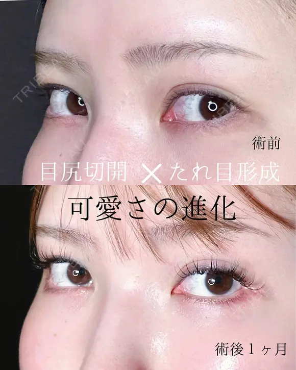 目尻切開＋下眼瞼拡大・下制限（タレ目形成） 皮膚＋結膜 after画像 メイン用