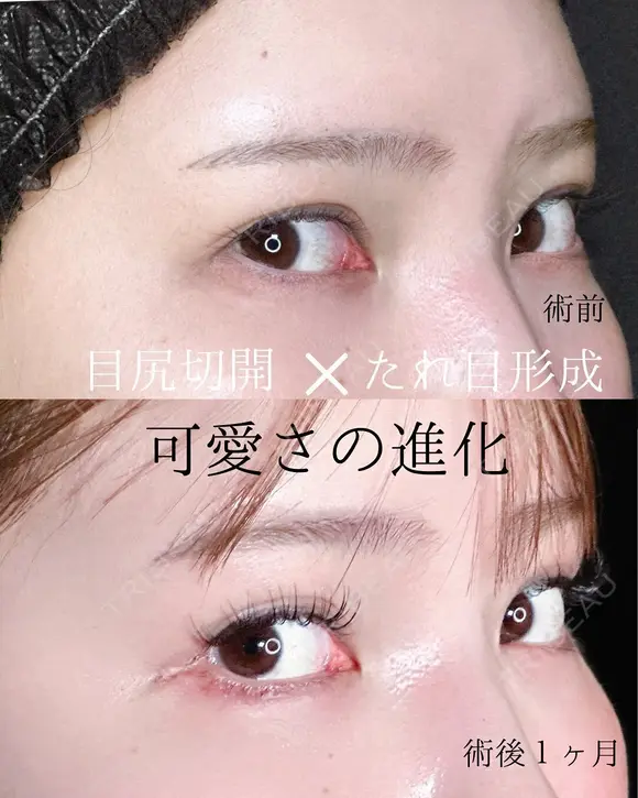 目尻切開＋下眼瞼拡大・下制限（タレ目形成） 皮膚＋結膜 after画像 メイン用