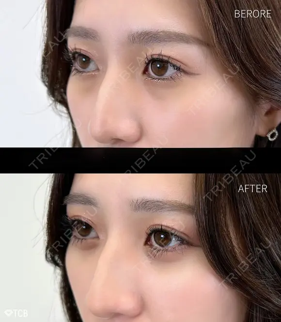 目の下のクマ取り・目の下のたるみ（ふくらみ）取り before画像 メイン用