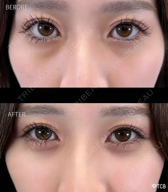 目の下のクマ取り・目の下のたるみ（ふくらみ）取り after画像 メイン用