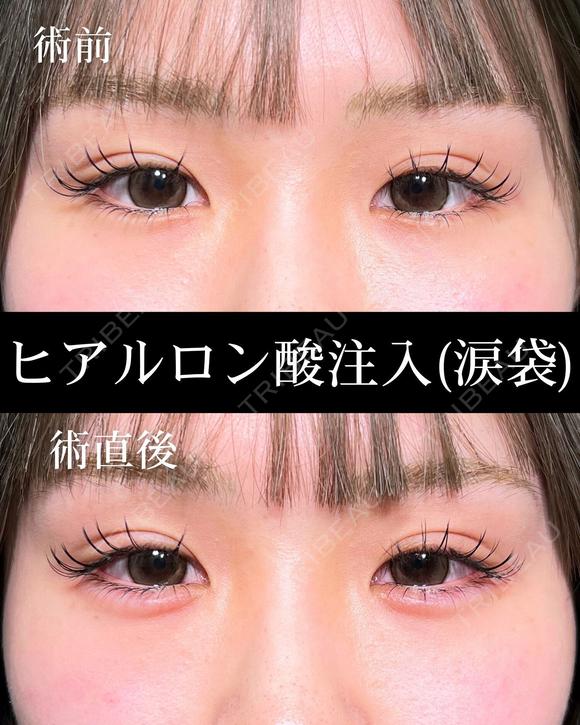 ヒアルロン酸注入（涙袋） before画像 メイン用