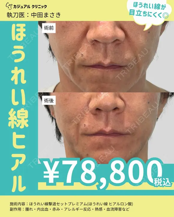ほうれい線撃退セットプレミアム（ほうれい線 ヒアルロン酸 before画像 メイン用