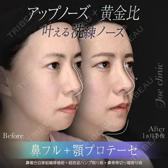 鼻フルコース（鼻複合自家組織移植術）＋筋膜移植＋超音波鼻骨骨削り術＋顎プロテーゼ挿入術 before画像 メイン用