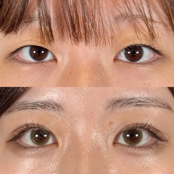 二重埋没法 before画像 メイン用
