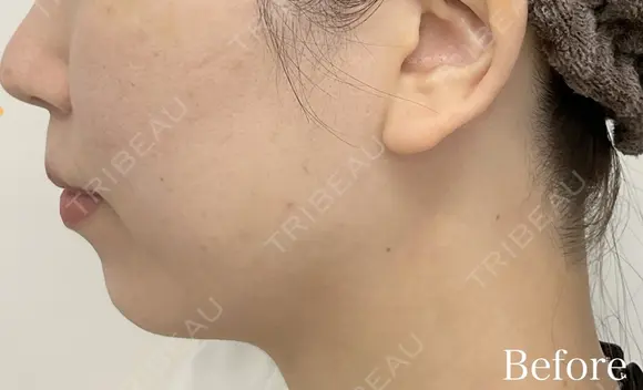 顎ヒアルロン酸 before画像 メイン用