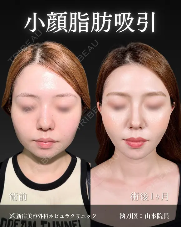 山本医師の🎀小顔整形🎀 30日後 メイン用