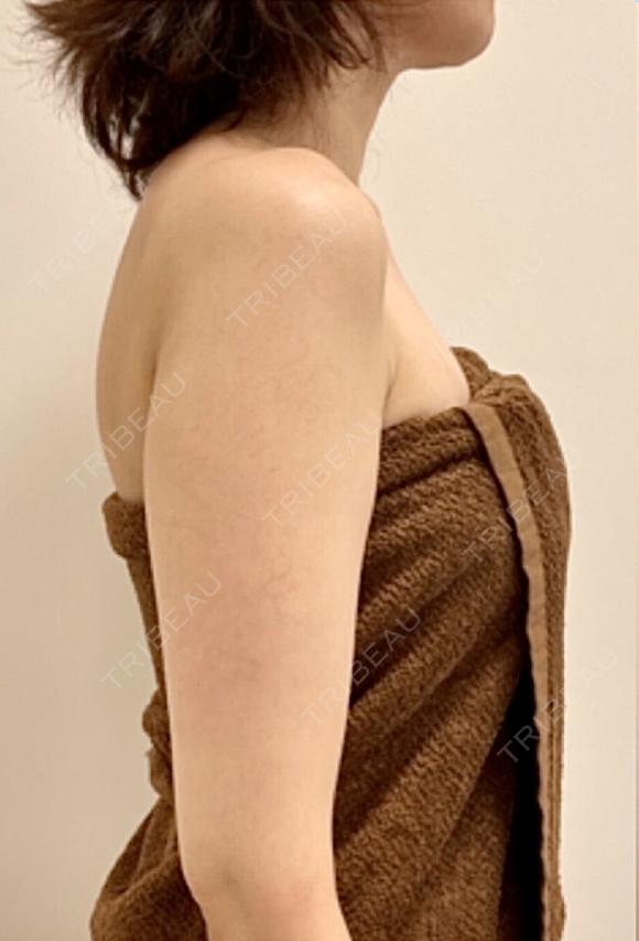 二の腕の脂肪吸引 before画像 メイン用