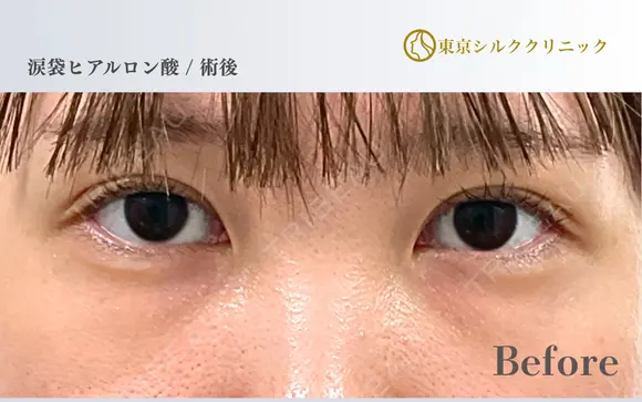 涙袋ヒアルロン酸 before画像 メイン用