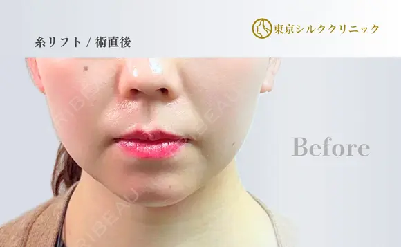 糸リフト before画像 メイン用