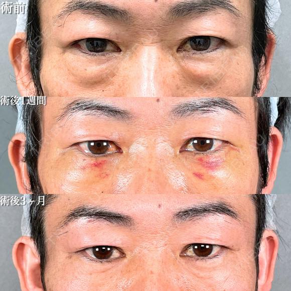 目の下の・クマ取り/脂肪注入(目の下・ゴルゴライン) before画像 メイン用