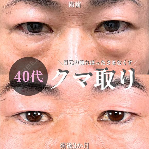目の下の・クマ取り/脂肪注入(目の下・ゴルゴライン) 90日後 メイン用
