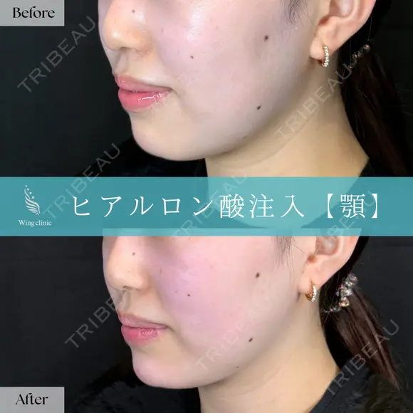 Wing式 顎ヒアルロン酸形成 after画像 メイン用
