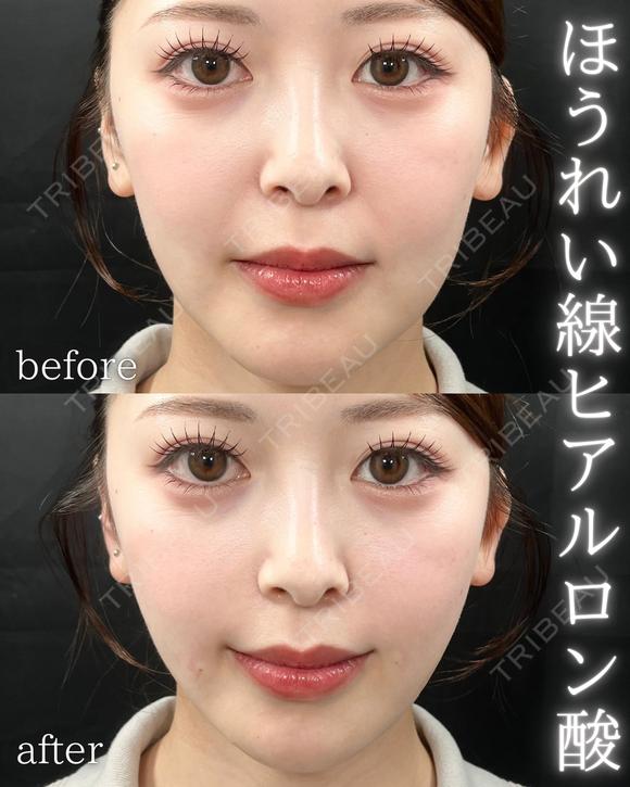 ほうれい線ヒアルロン酸 before画像 メイン用