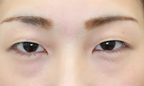 フォーエバーブリリアント埋没法 before画像 メイン用