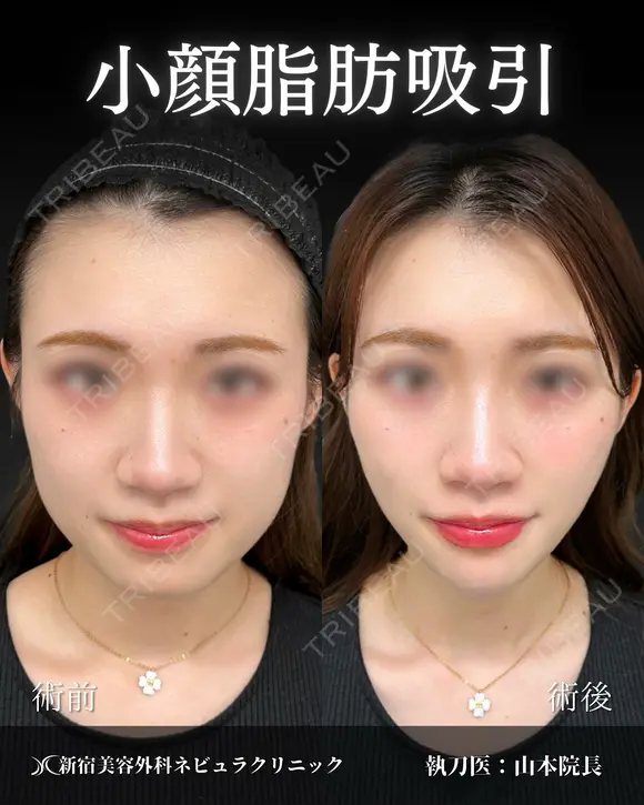 山本医師の🎀小顔整形🎀 90日後 メイン用