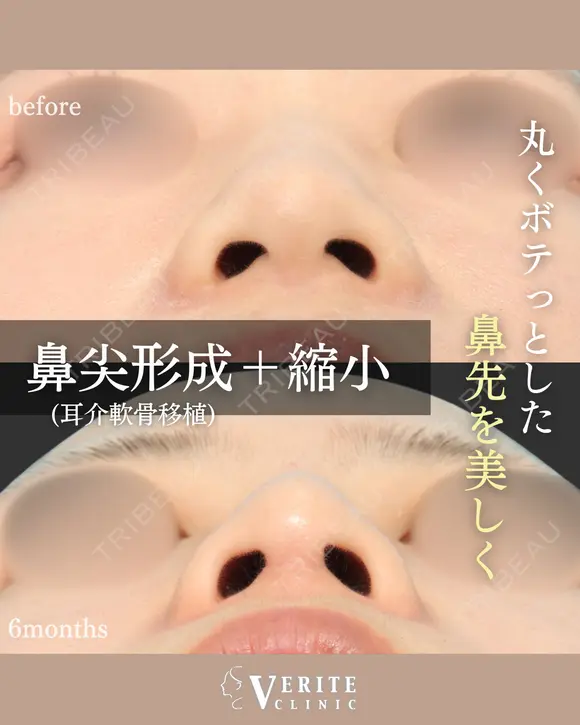 鼻尖形成（耳介軟骨移植）＋鼻尖縮小＋眉間鼻筋オーダーメイドプロテーゼ｜丸い鼻先を美しく✨ before画像 メイン用