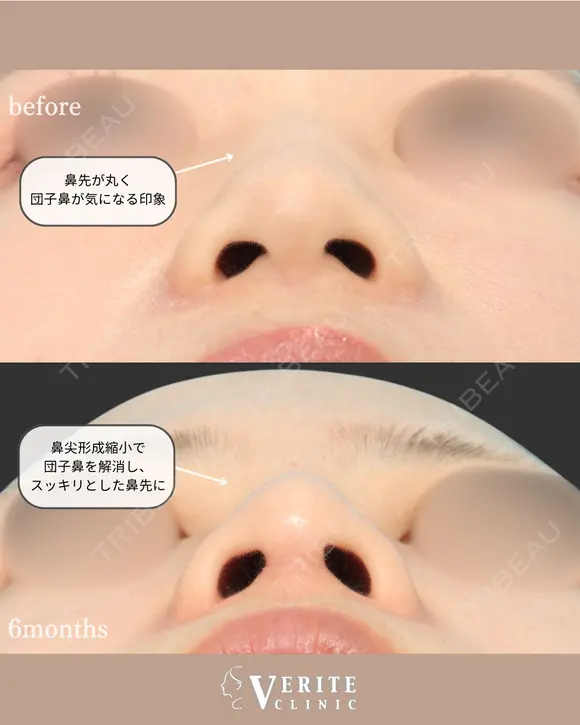 鼻尖形成（耳介軟骨移植）＋鼻尖縮小＋眉間鼻筋オーダーメイドプロテーゼ｜丸い鼻先を美しく✨ after画像 メイン用