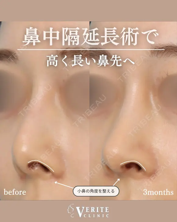 鼻中隔延長＋貴族手術｜中顔面発達✨ after画像 メイン用